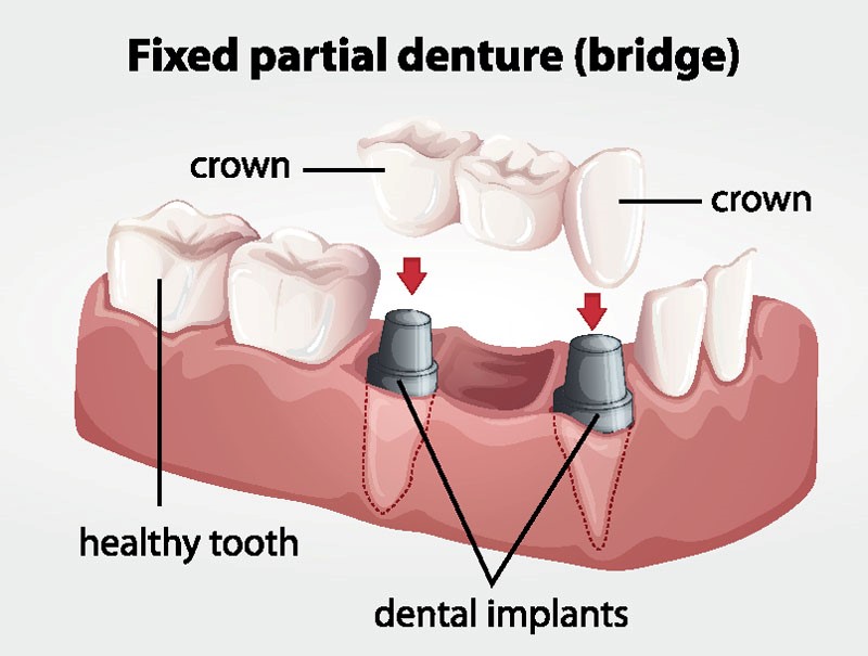 Front Teeth Dentures Olaton KY 42361